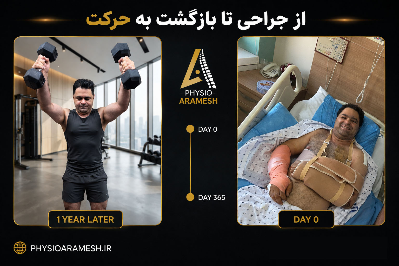از جراحی تاندون شانه تا بازگشت به حرکت